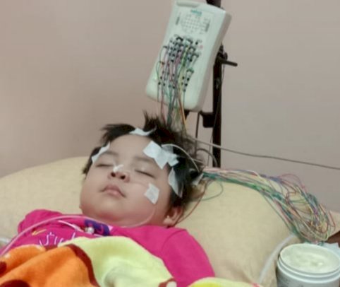 Miris, Balita Perempuan di Kerinci Ini Derita Radang Otak dan Butuh Uluran Tangan