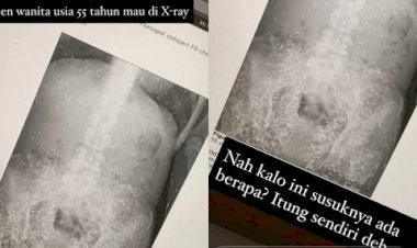 Viral X-ray Pasien Wanita 55 Tahun Dipenuhi Susuk: Benarkah Susuk Bikin Jadi Cantik?