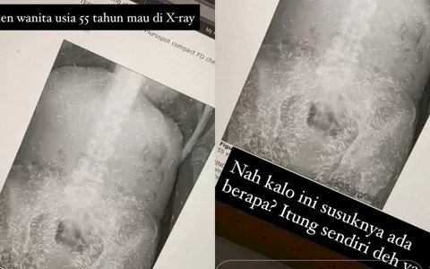 Viral X-ray Pasien Wanita 55 Tahun Dipenuhi Susuk: Benarkah Susuk Bikin Jadi Cantik?