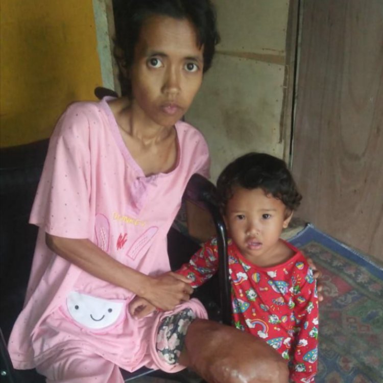 Miliki Anak yang Masih Kecil, Seorang Ibu di Muarojambi Harus Berjuang Melawan Tumor Ganas