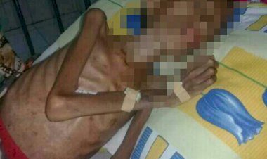 RSUD RM Serius Tangani Noval Penderita Gizi Buruk yang Yatim Piatu