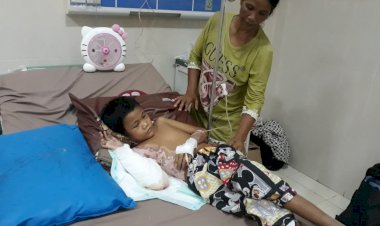 Diduga Dianiaya Ayah Tiri, Bocah Asal Muarojambi Ini Alami Luka Bakar Serius