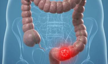 Begini Gejala Kanker Usus dan Faktor Risikonya