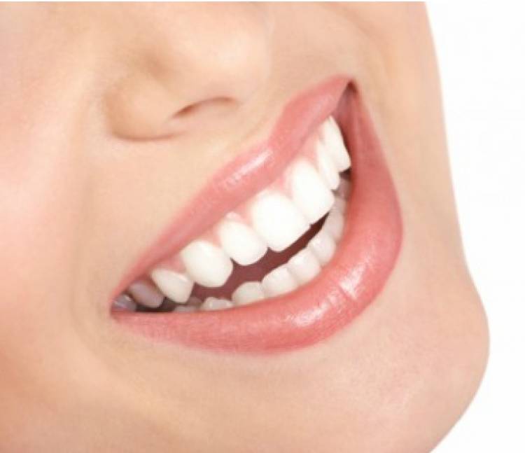 Veneer Gigi, Untuk Kesehatan atau Gaya Hidup?