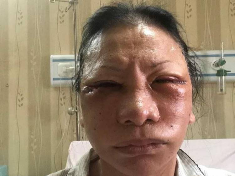 Sedot Lemak Pipi Seperti Ratna Disarankan untuk Wajah Chubby dan Usia Muda 