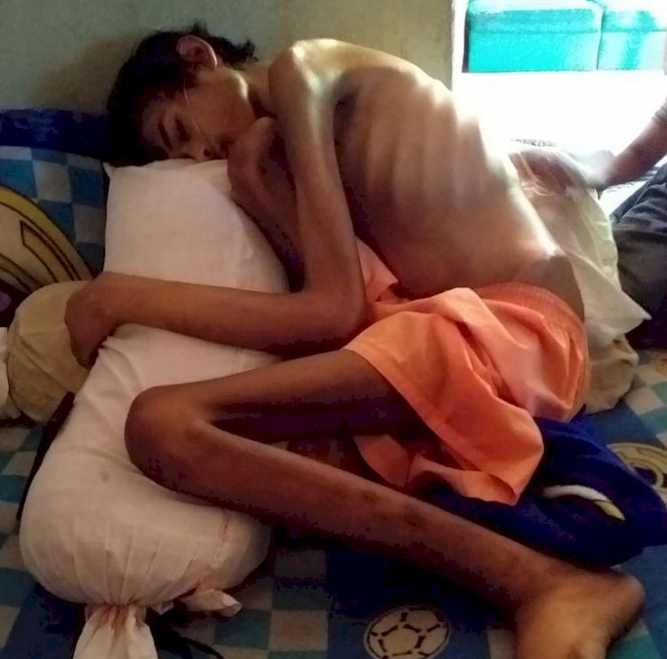 Tinggal Kulit Pembalut Tulang Karena Sakit, Rachju Anak Yatim ini Butuh Uluran Tangan