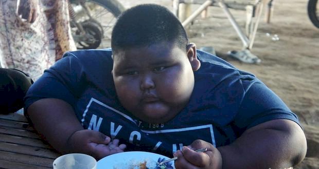 Bocah 7 Tahun Berbobot 101 Kg Asal Karawang Meninggal Dunia