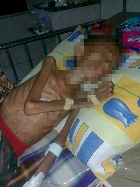 RSUD RM Serius Tangani Noval Penderita Gizi Buruk yang Yatim Piatu