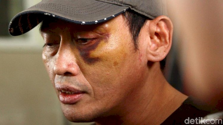 Polisi Sebut Munarman FPI Dalam Kasus Penganiayaan Ninoy Karundeng