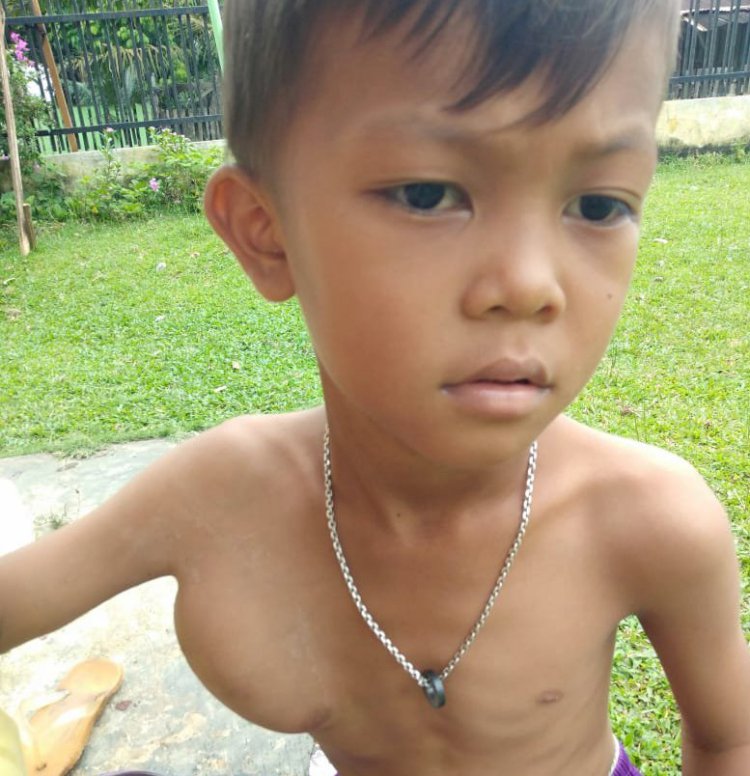 Derita Tumor di Ketiak, Bocah Enam Tahun di Jujuhan Bungo Ini Butuh Uluran Tangan Dermawan
